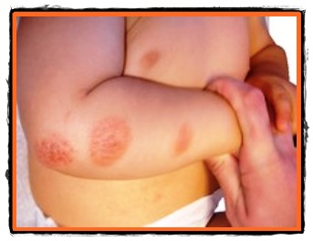 Eczema boala de piele